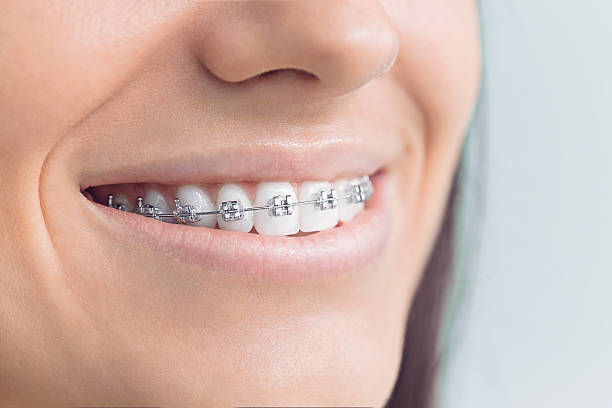 Dental Bonding in Jan Phyl Village, FL